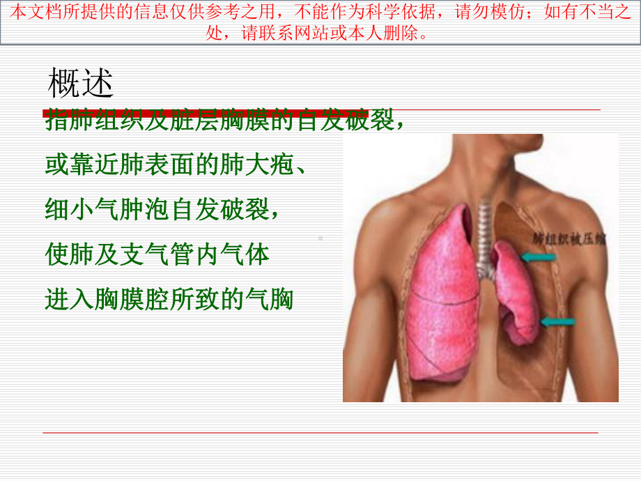 液气胸病人医疗护理查房培训课件.ppt_第1页