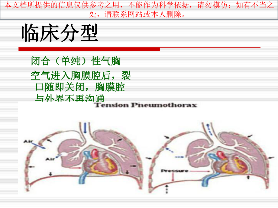 液气胸病人医疗护理查房培训课件.ppt_第3页