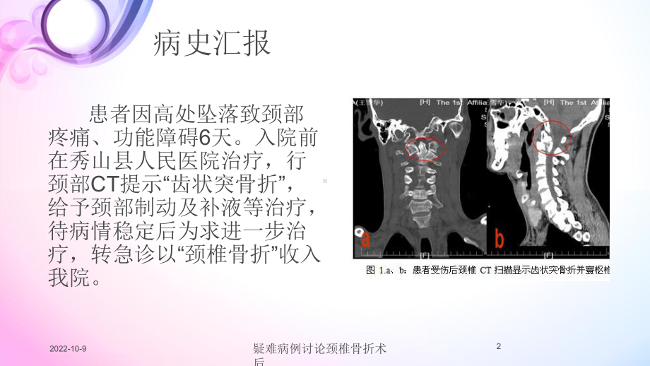 疑难病例讨论颈椎骨折术后培训课件.ppt_第2页