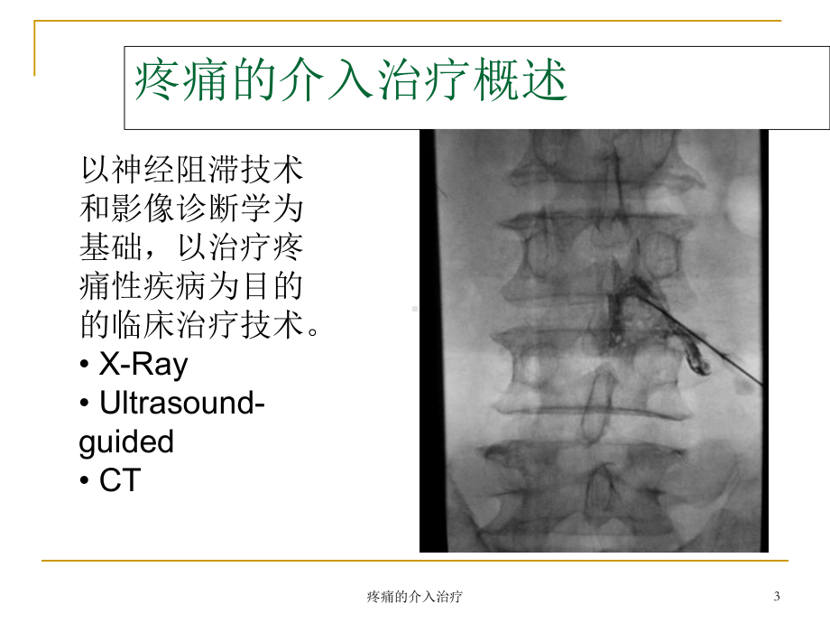 疼痛的介入治疗培训课件.ppt_第3页