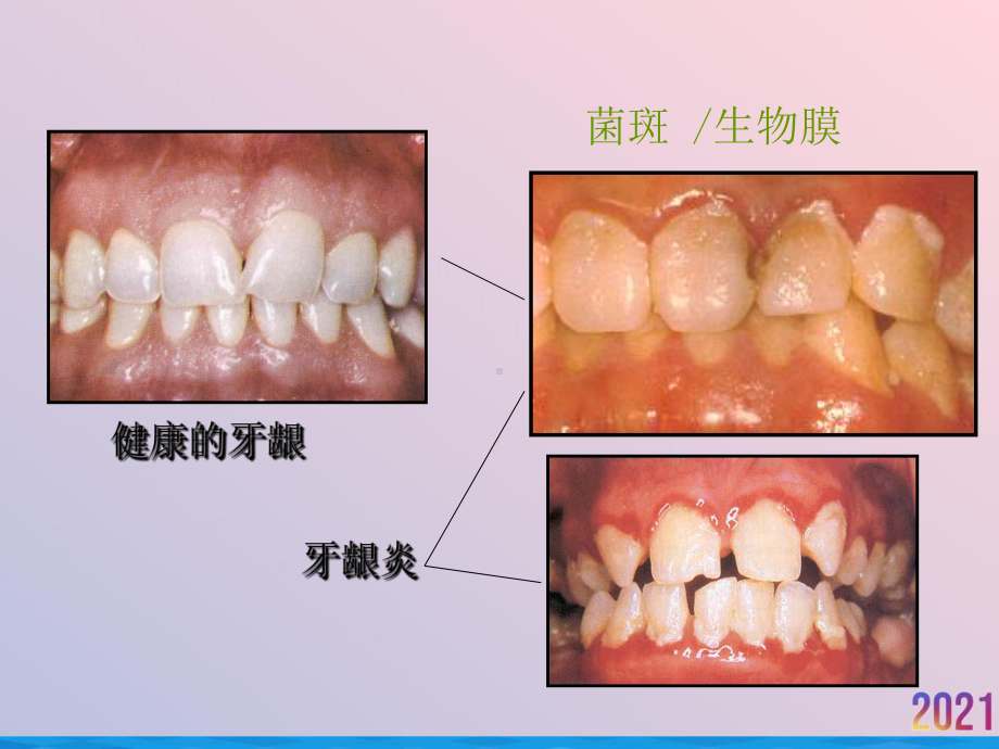 牙周炎与全身疾病慢病发言课件.ppt_第3页