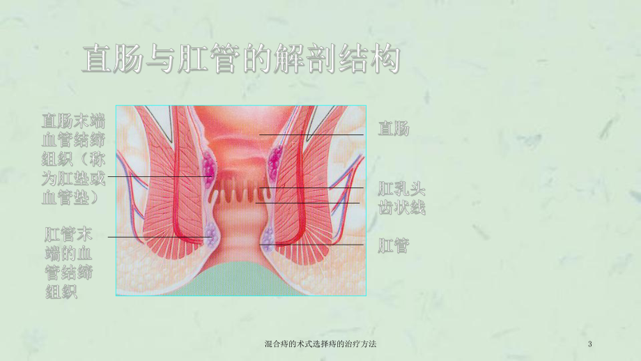 混合痔的术式选择痔的治疗方法课件.ppt_第3页