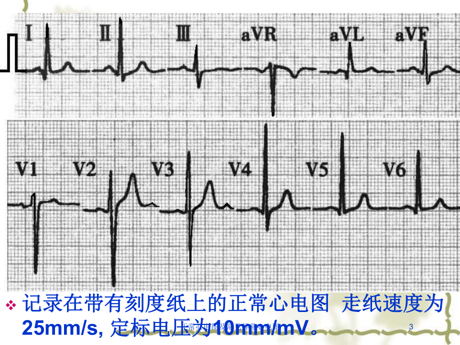 正常心电图及常见异常心电图培训课件.ppt_第3页