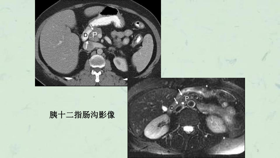 沟槽性胰腺炎课件.ppt_第3页