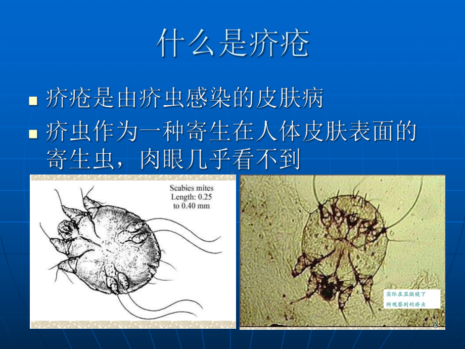 疥疮的防与治课件.ppt_第2页