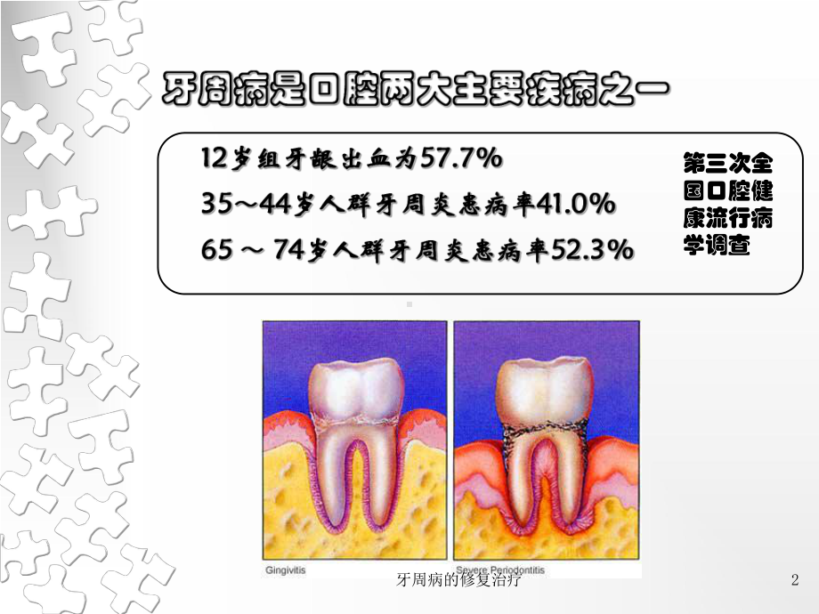 牙周病的修复治疗培训课件.ppt_第2页