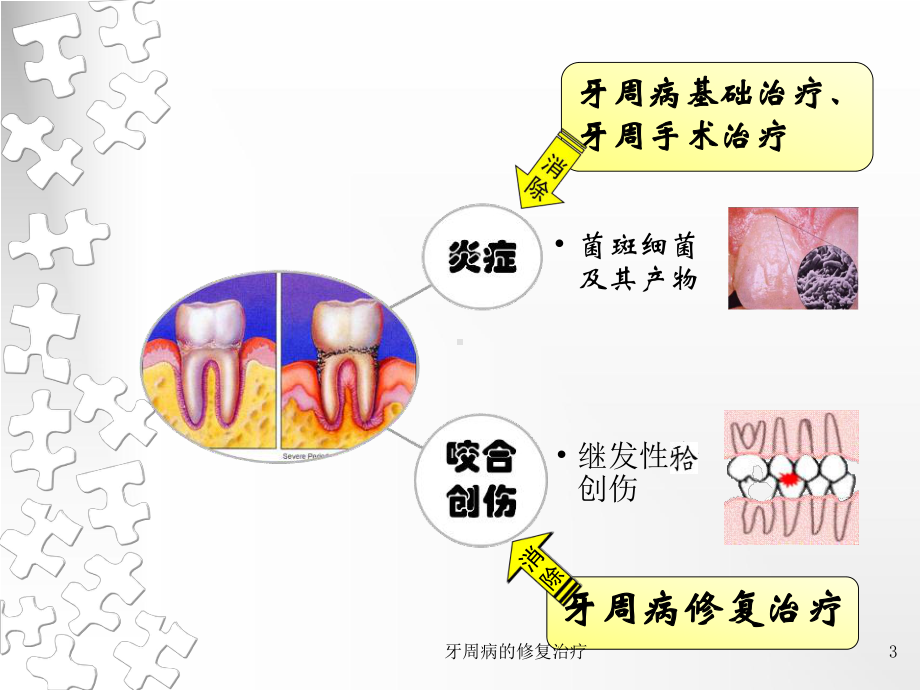 牙周病的修复治疗培训课件.ppt_第3页