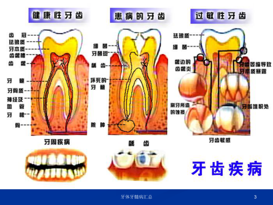 牙体牙髓病汇总培训课件.ppt_第3页