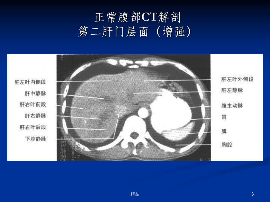 消化系统疾病CT影像阅片基础课件.ppt_第3页