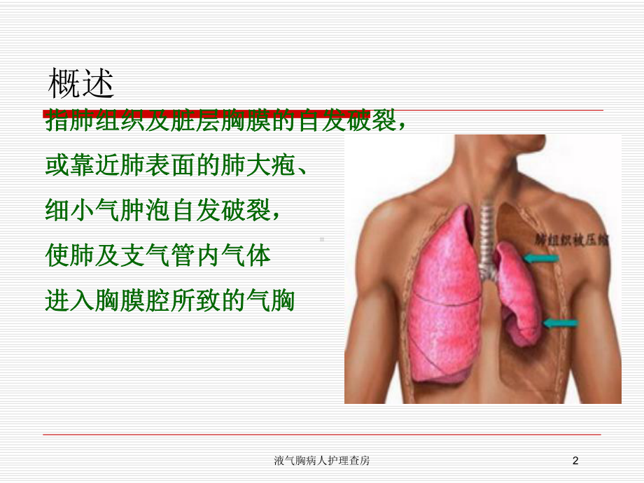 液气胸病人护理查房培训课件.ppt_第2页