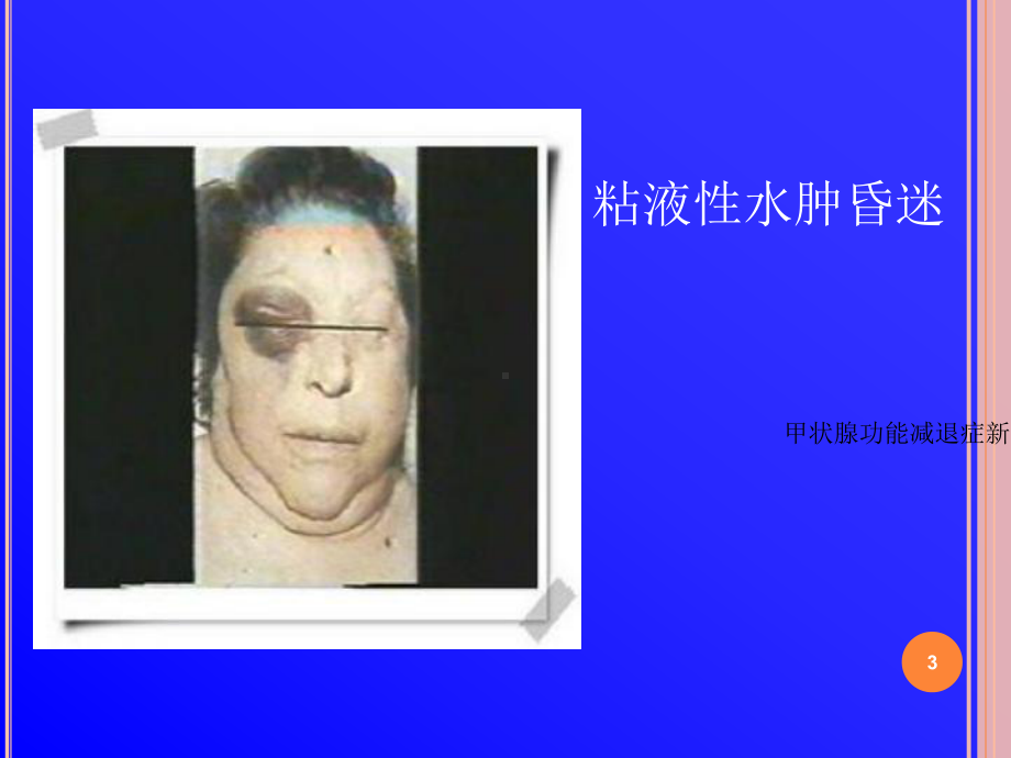 甲状腺功能减退症新版培训课件.ppt_第3页