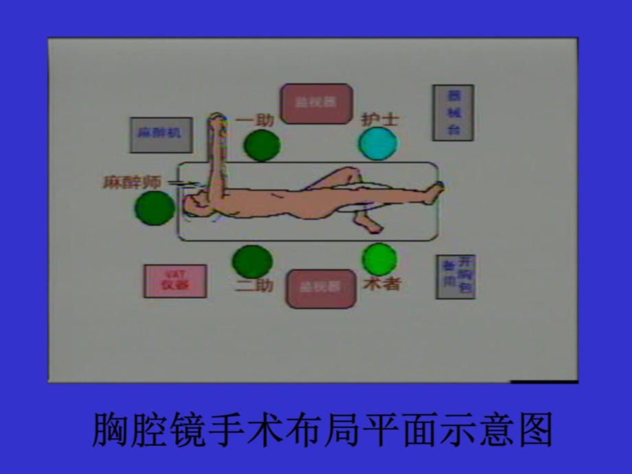 电视胸腔镜临床应用课件.ppt_第3页