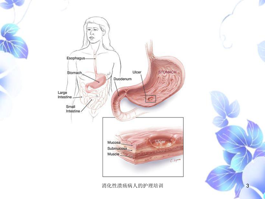 消化性溃疡病人的护理培训培训课件.ppt_第3页