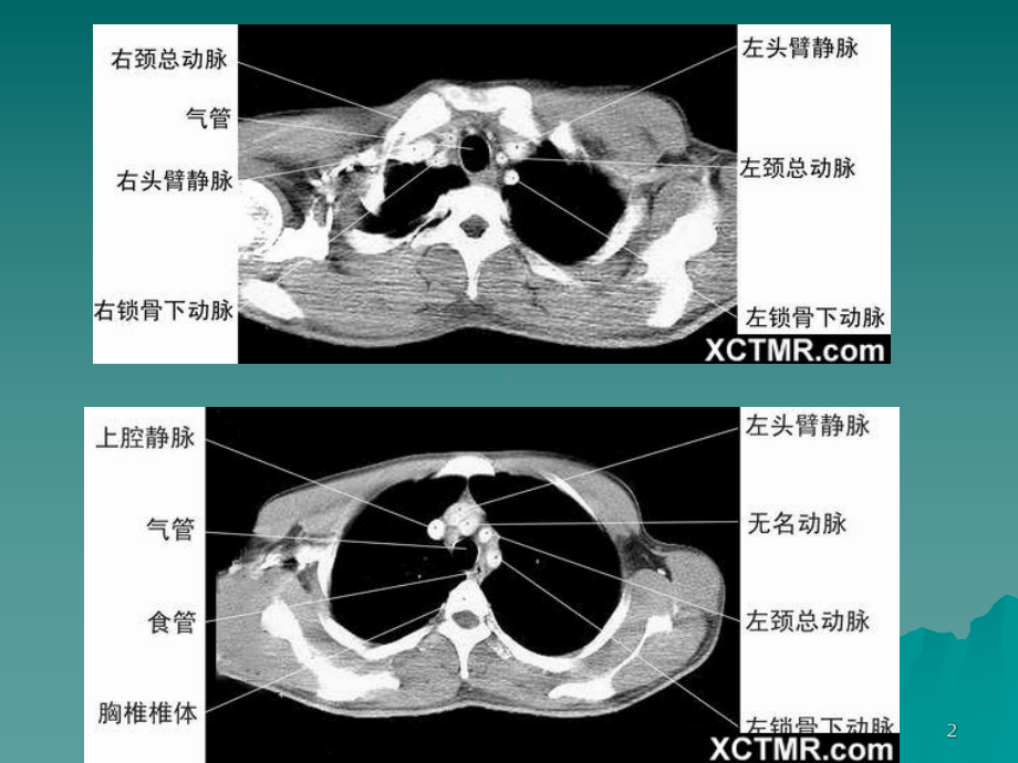 正常胸部CT课件.ppt_第2页