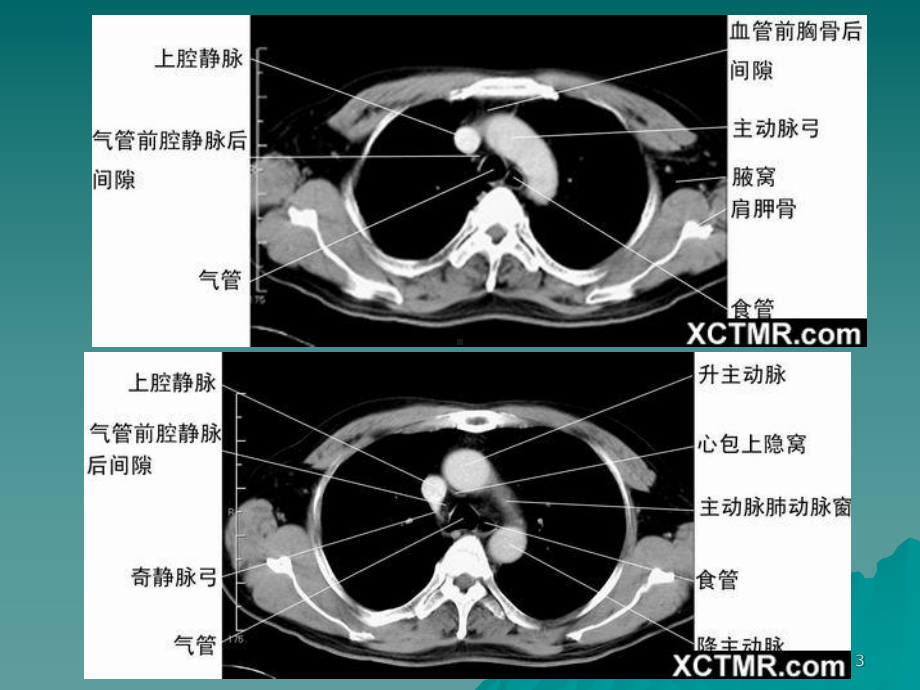 正常胸部CT课件.ppt_第3页