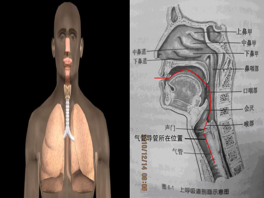 气管切开病人术后护理培训培训课件.ppt_第2页