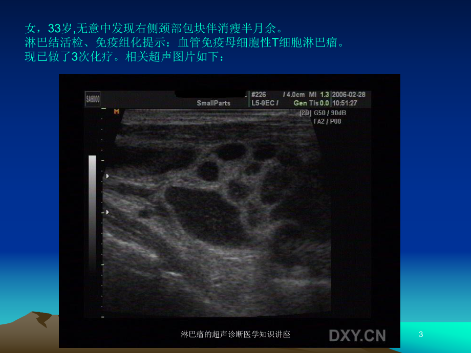 淋巴瘤的超声诊断医学知识讲座培训课件.ppt_第3页