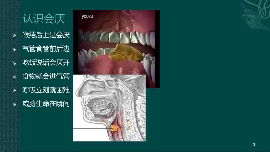 气道异物梗阻的急救处理课件.ppt_第3页