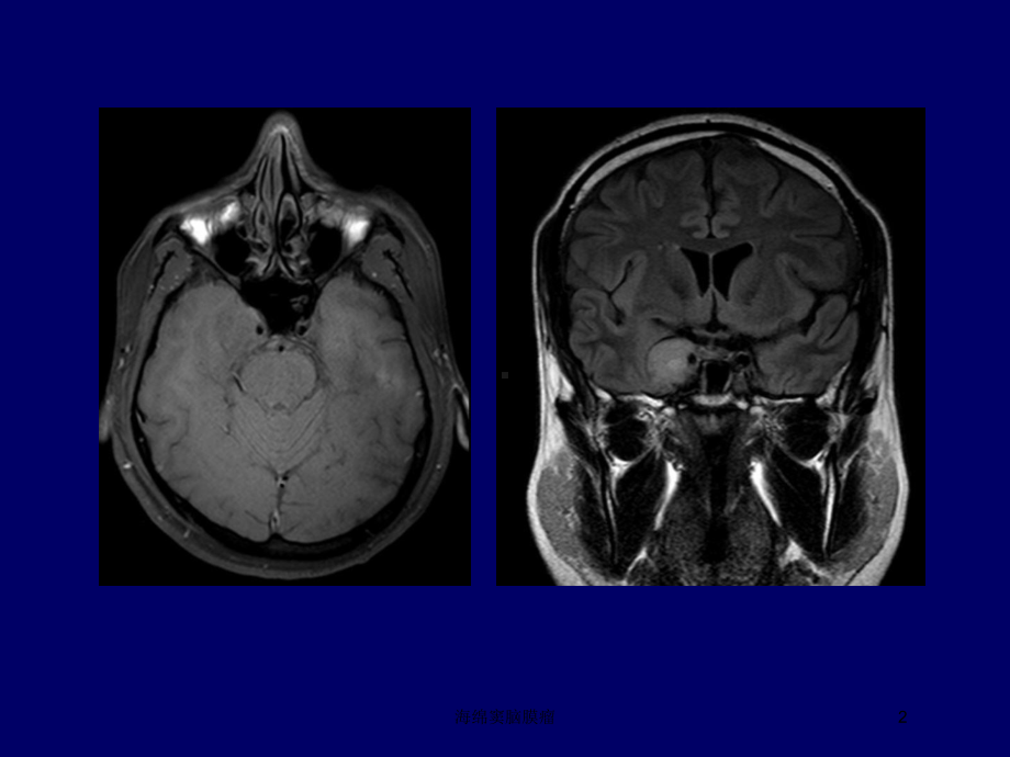 海绵窦脑膜瘤培训课件.ppt_第2页