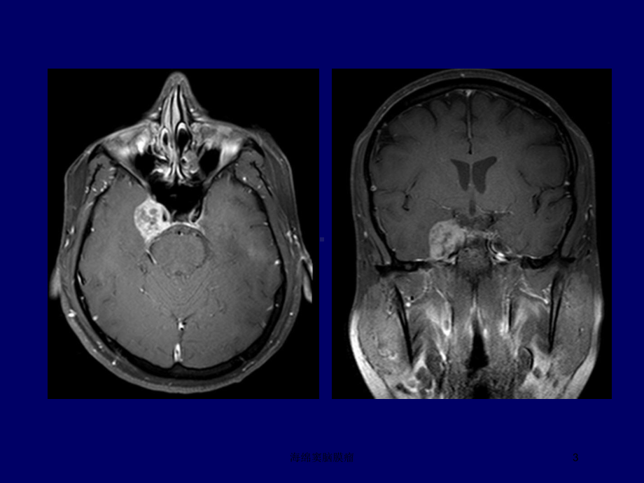 海绵窦脑膜瘤培训课件.ppt_第3页