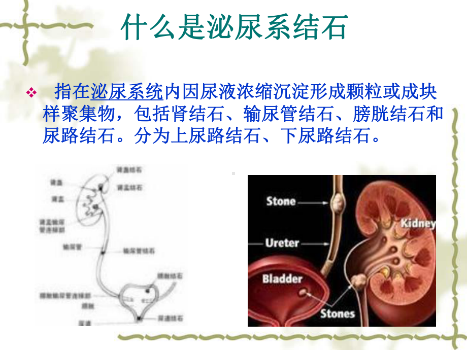 泌尿结石病人饮食指导讲课稿课件.ppt_第3页