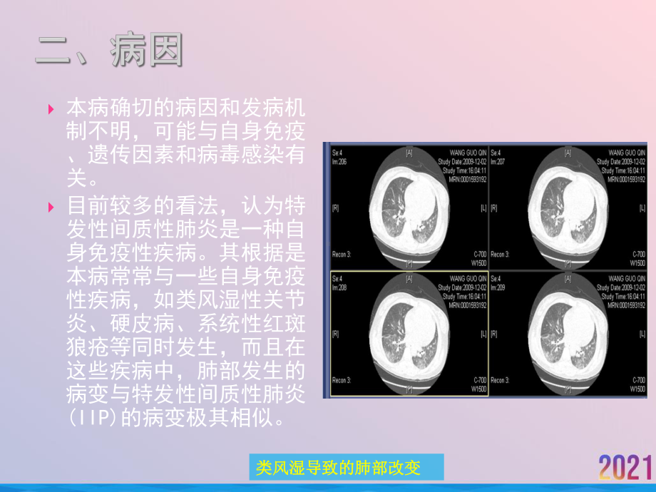 特发性间质性肺炎的护理课件.ppt_第3页