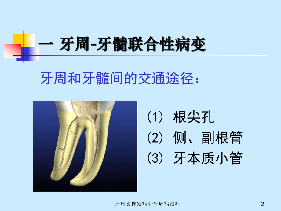 牙周炎伴发病变牙周病治疗课件.ppt_第2页