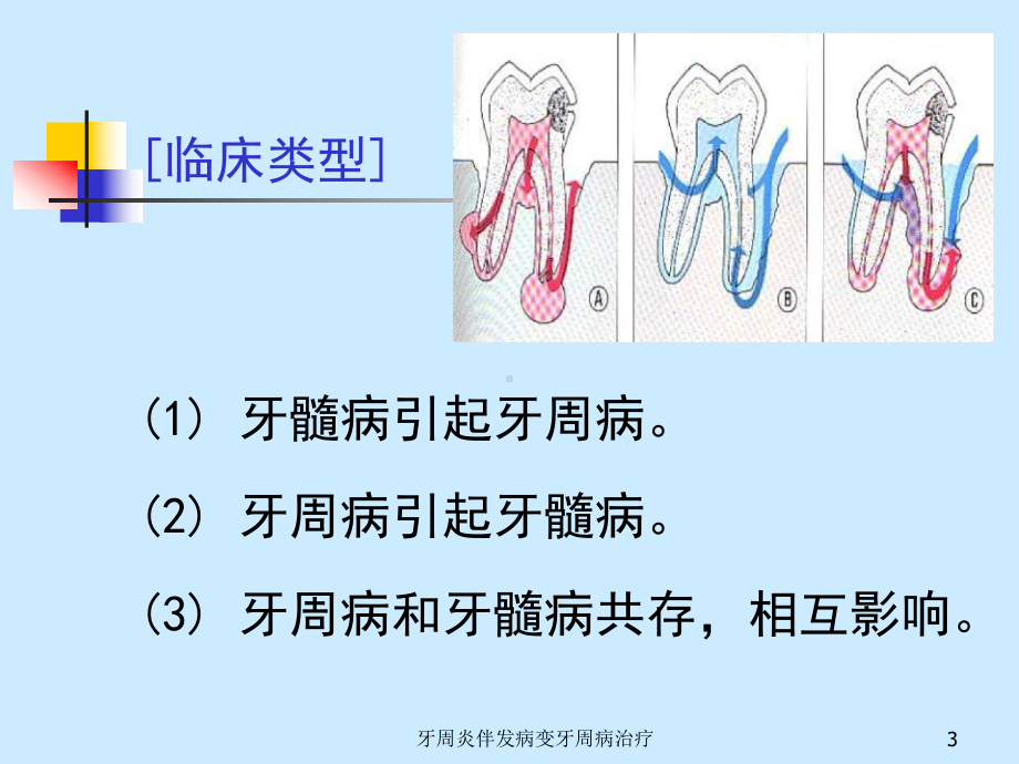 牙周炎伴发病变牙周病治疗课件.ppt_第3页