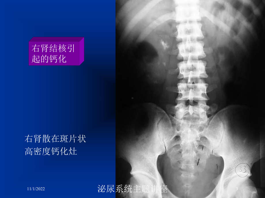 泌尿系统主题讲座培训课件.ppt_第3页