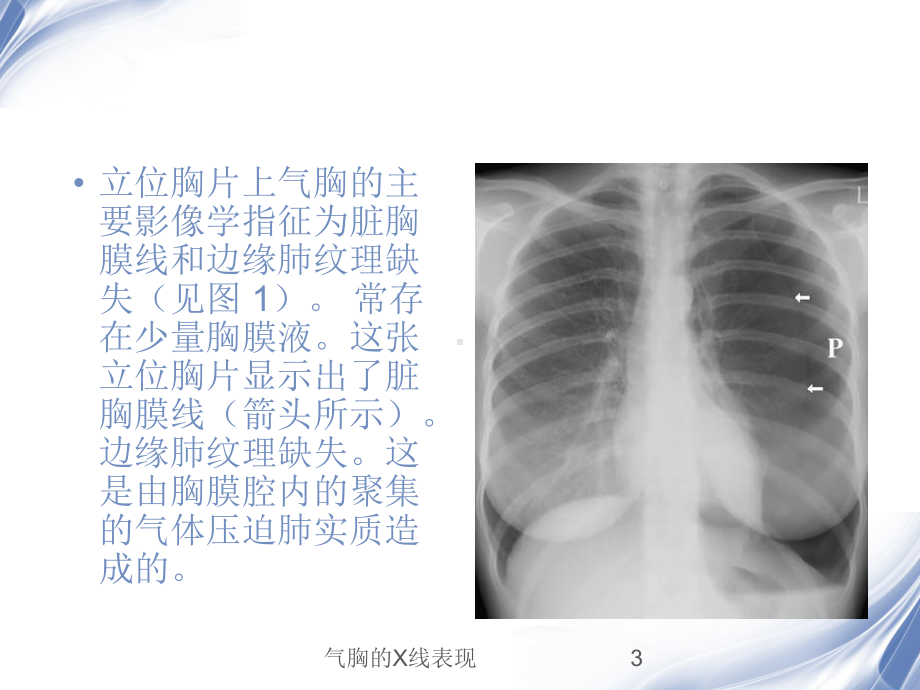 气胸的X线表现培训课件.ppt_第3页