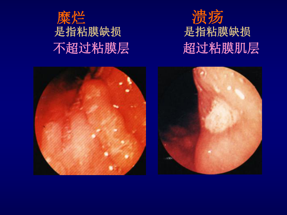 消化性溃疡-人卫8版课件.ppt_第3页