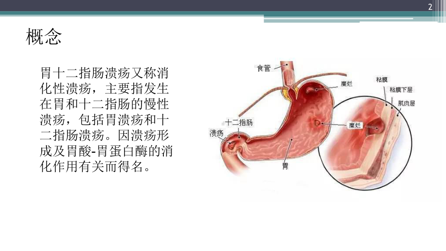 消化性溃疡病因病理课件.ppt_第2页