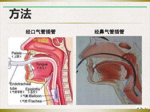 气管插管的护理课件.pptx