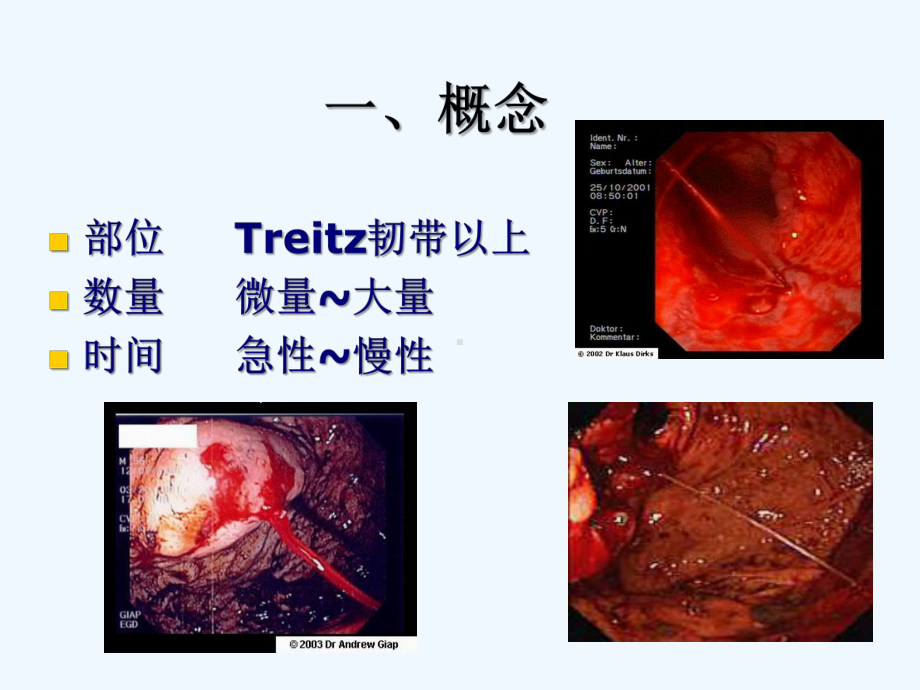 上消化道出血4.ppt_第3页