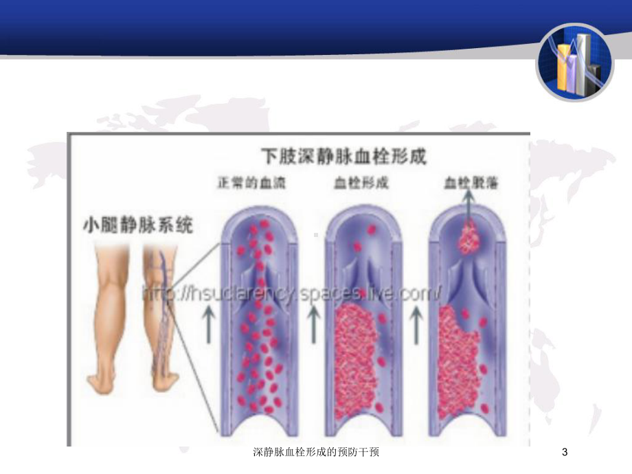 深静脉血栓形成的预防干预培训课件.ppt_第3页