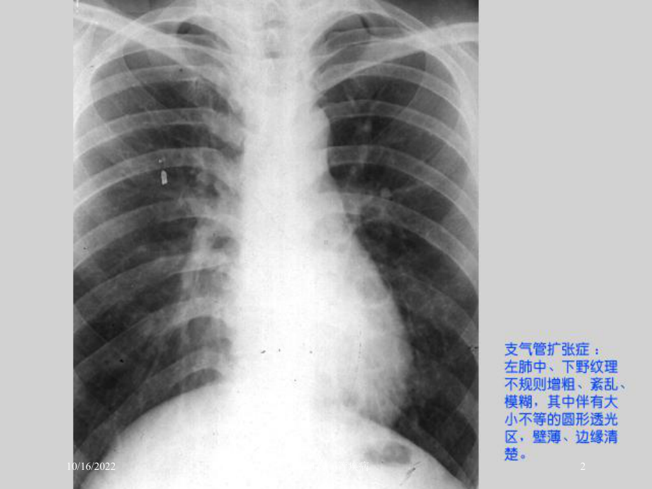 气管和支气管疾病培训课件.ppt_第2页