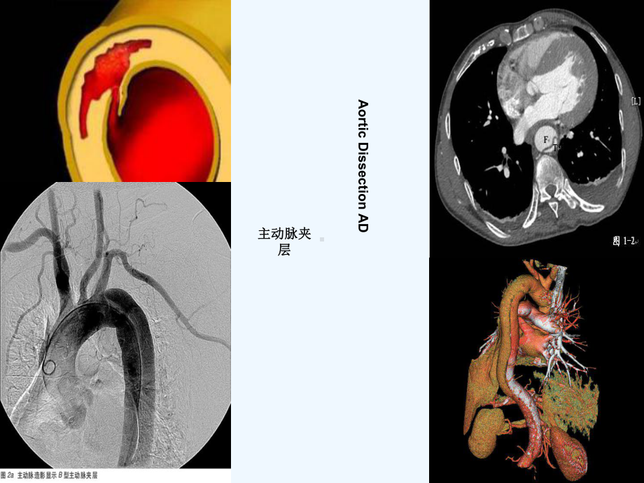 河南大学外科学主动脉夹层与周围血管病课件.ppt_第2页