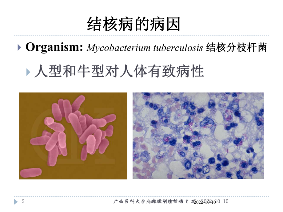 病理学结核病培训课件.ppt_第2页