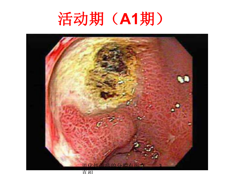 消化性溃疡的分期有图有真相培训课件.ppt_第3页