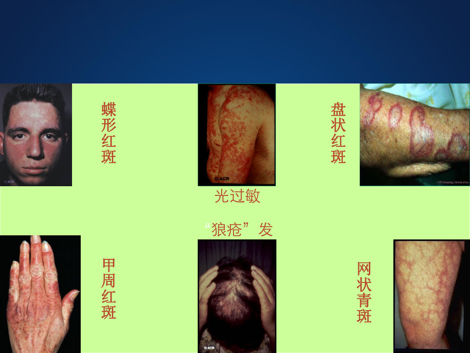 狼疮性肾炎幻灯课件(模板).pptx_第2页