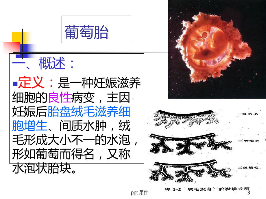 滋养细胞疾病的护理-课件.ppt_第3页