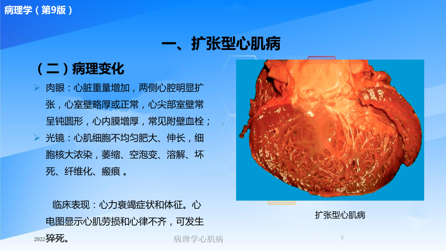 病理学心肌病培训课件.ppt_第3页