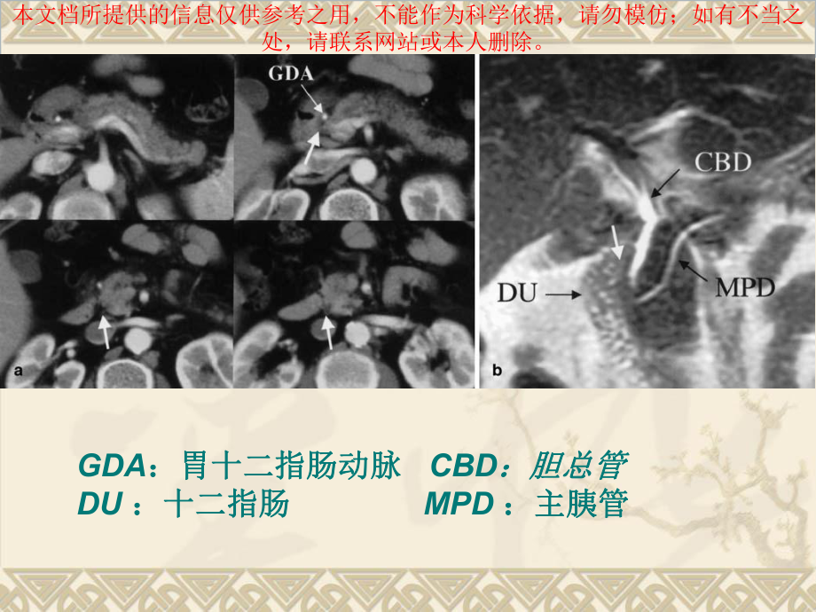 沟槽性胰腺炎宣讲培训课件.ppt_第3页