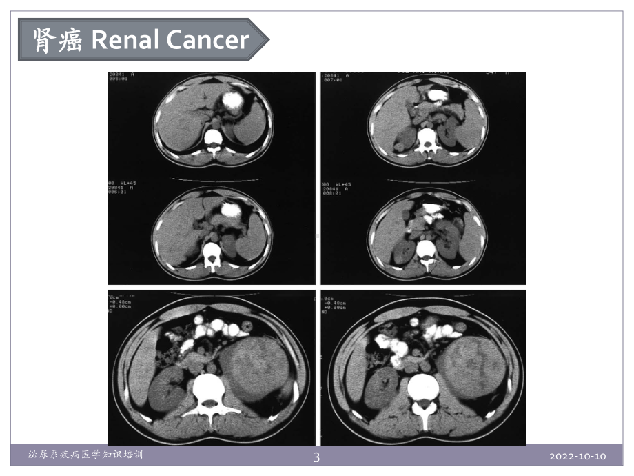 泌尿系疾病医学知识培训培训课件.ppt_第3页