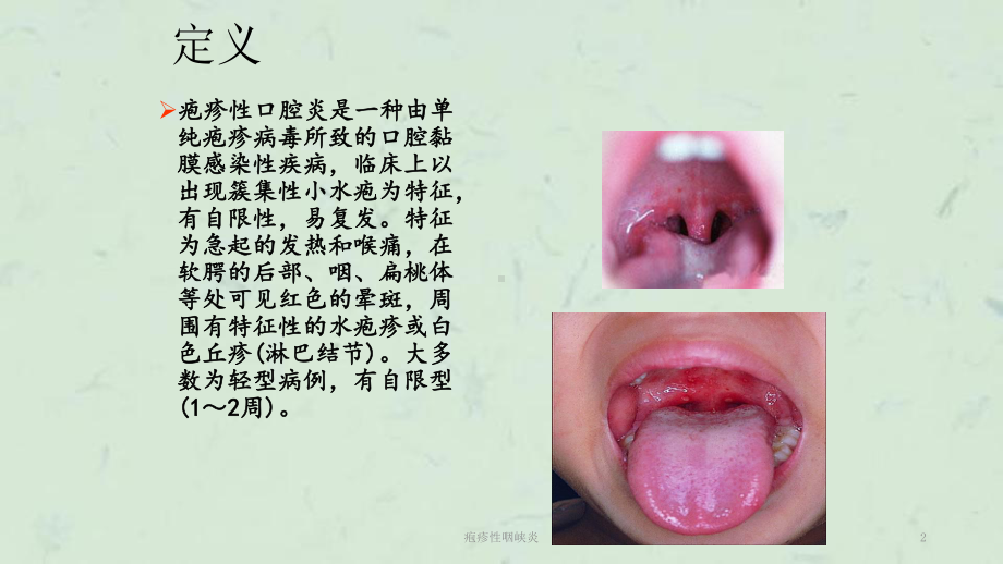 疱疹性咽峡炎课件.ppt_第2页