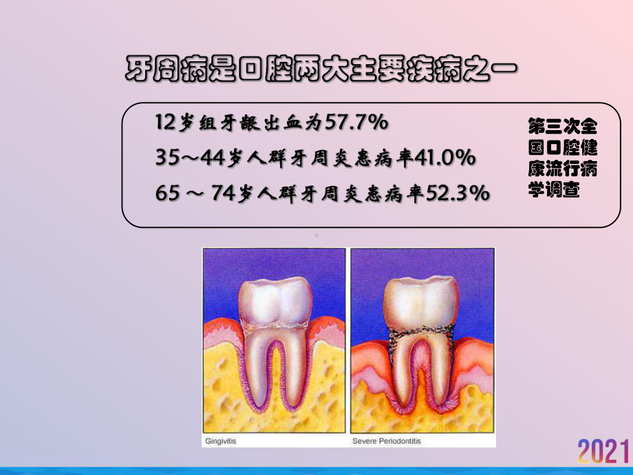 牙周病的修复治疗课件.ppt_第2页