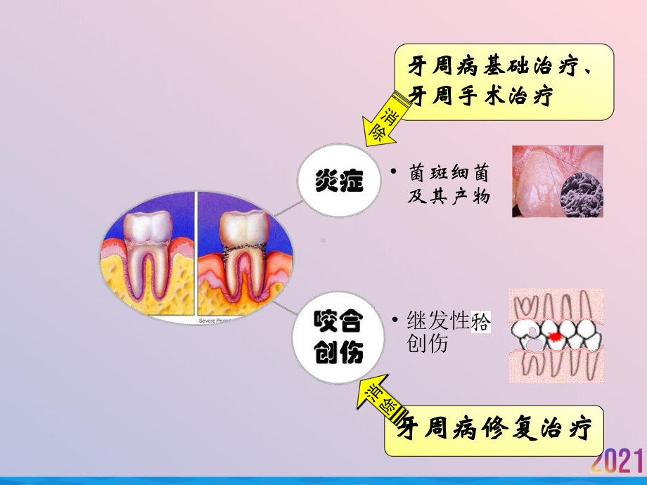 牙周病的修复治疗课件.ppt_第3页