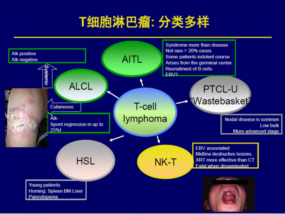 治疗外周T细胞淋巴瘤的新型药物全面课件.pptx_第2页