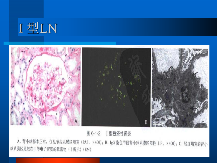 狼疮性肾炎病理分型及治疗课件.ppt_第3页