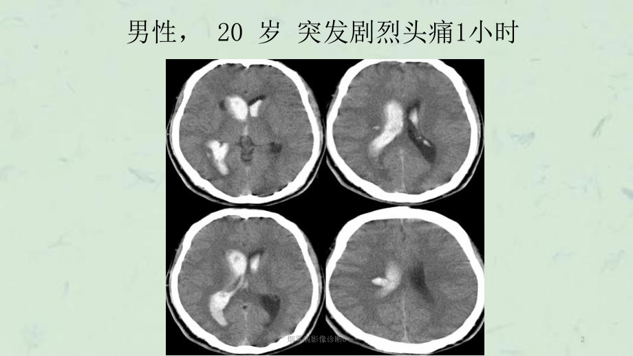 烟雾病影像诊断0课件.ppt_第2页